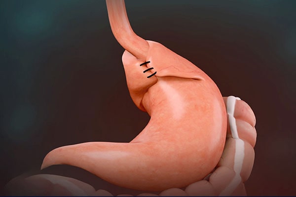 Cirugía Antireflujo Cuenca Dr David Barzallo