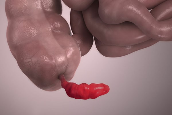 Cirugía de Apéndice Cuenca Dr David Barzallo