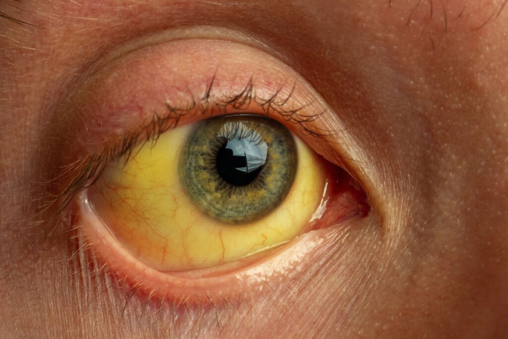 Tumor Vias Biliares Cirujano General Cuenca Dr David Barzallo-min